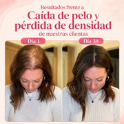 Resultados de Vosbella para la caída del pelo y pérdida de densidad capilar en 30 días